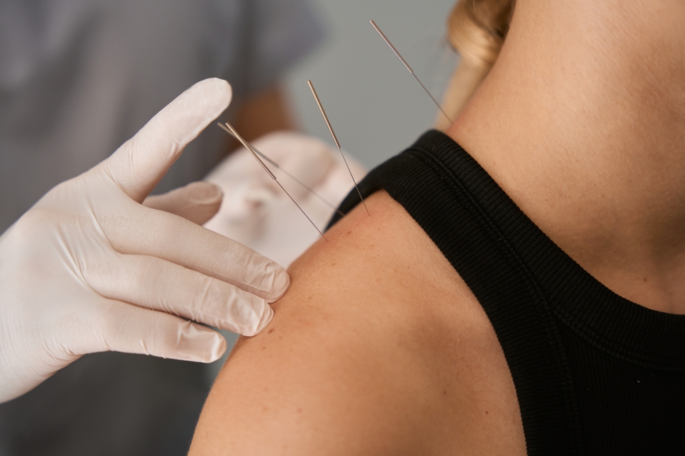 Acupuntura a domicilio en Lima para aliviar el estrés y mejorar la salud.
