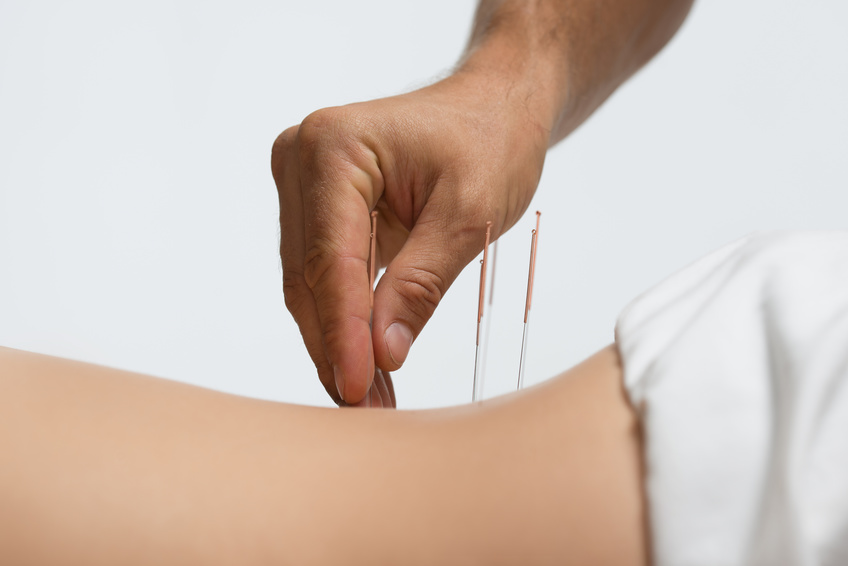Sesión de acupuntura en Lima para aliviar el dolor muscular y articular de manera natural