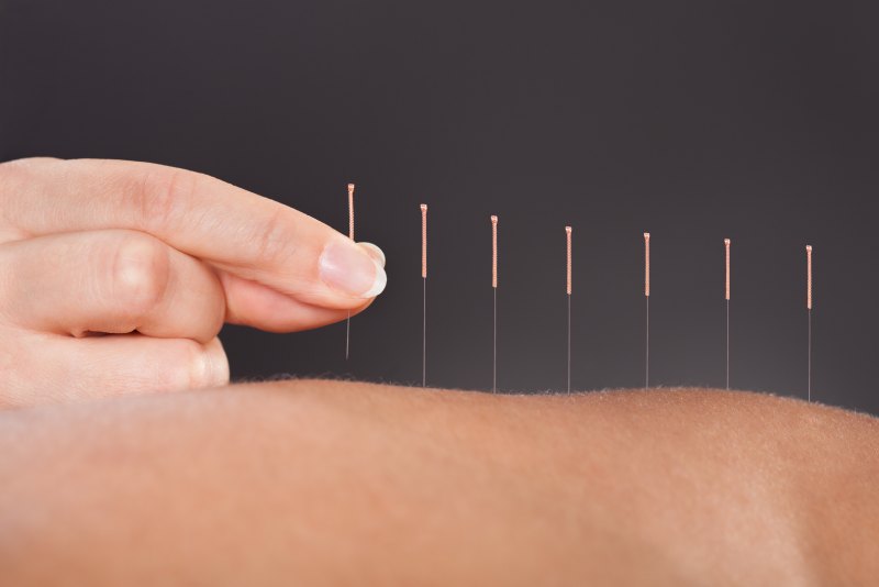 Terapeuta realizando una sesión de acupuntura en la espalda de un paciente, destacando la práctica clínica de la acupuntura.