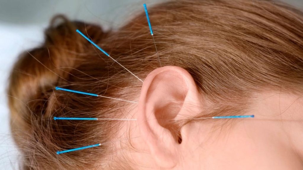 Aplicación de acupuntura en la oreja para estimular puntos de energía y mejorar la salud según la medicina tradicional china