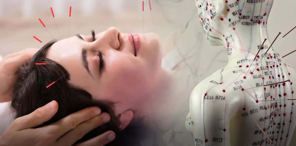Beneficios de la acupuntura en Lima para la salud