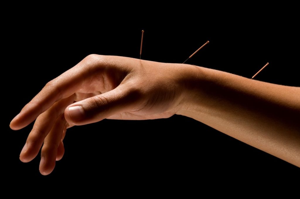 Paciente recibiendo una sesión de acupuntura con agujas insertadas en la mano, ilustrando la práctica de la medicina tradicional china.